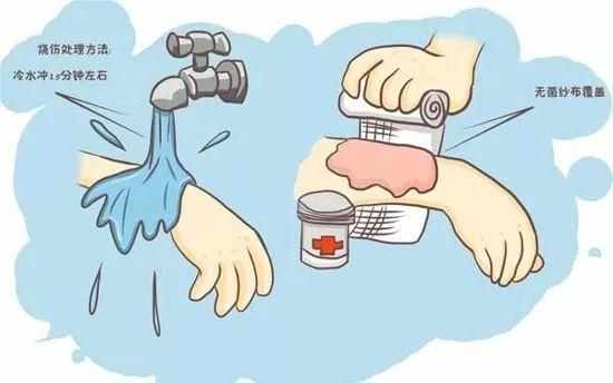 烧水烫伤紧急处理,烫伤烧伤的紧急处理ppt