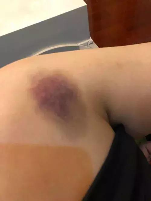 杭州女生打呼噜被舍友卡脖子,大学生打呼噜被舍友打后续