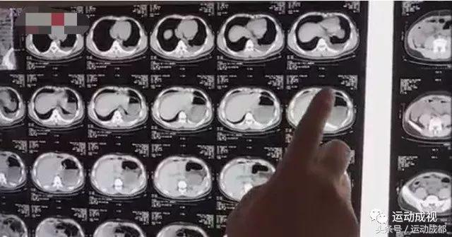 22岁小伙撸铁,22岁小伙子撸铁内脏撕裂