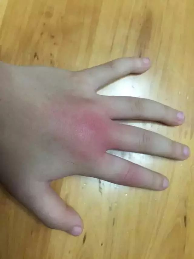初来乍到长沙不慎被蜈蚣咬伤,小孩被蜈蚣咬了怎么办有危险吗