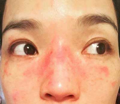 哪种皮肤适合氨基酸洗面奶,敏感肌肤适合氨基酸洗面奶吗