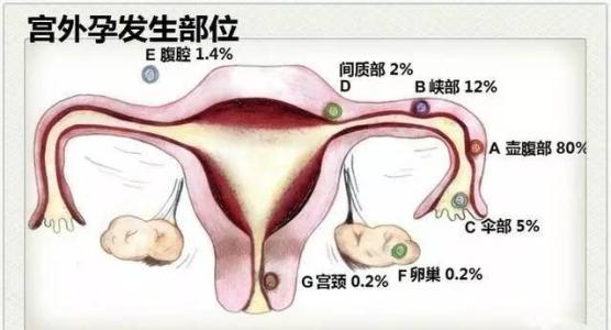 女朋友宫外孕导致死亡,腹痛24小时宫外孕死亡