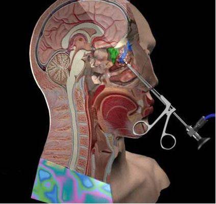 过敏性鼻炎像得了不治之症,过敏性鼻炎是不是什么大病