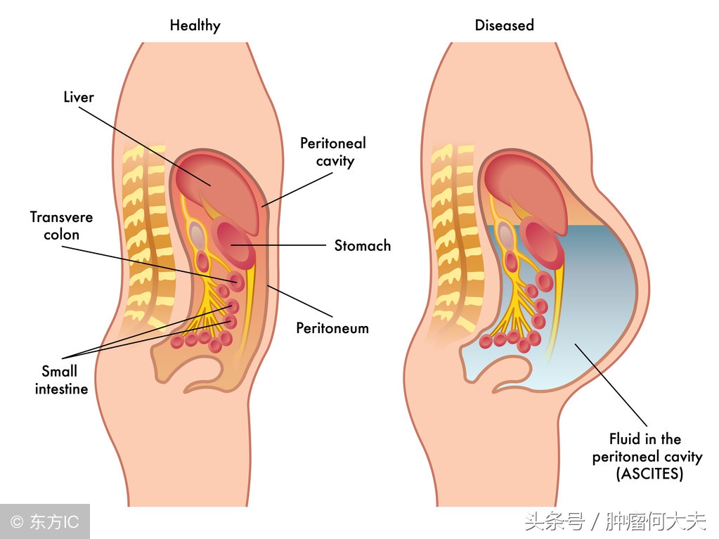 肿瘤晚期腹水怎么消除,癌症晚期腹水腹腔穿刺