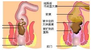 老人便秘别用泻药,老人便秘十大并发症