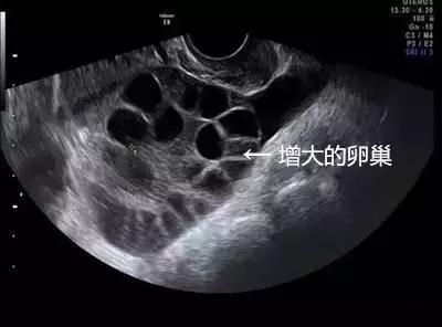 女大学生捐卵案完整,女大学生捐29个卵