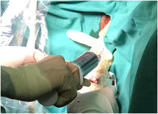 不开刀治疗囊肿,不开刀治囊肿