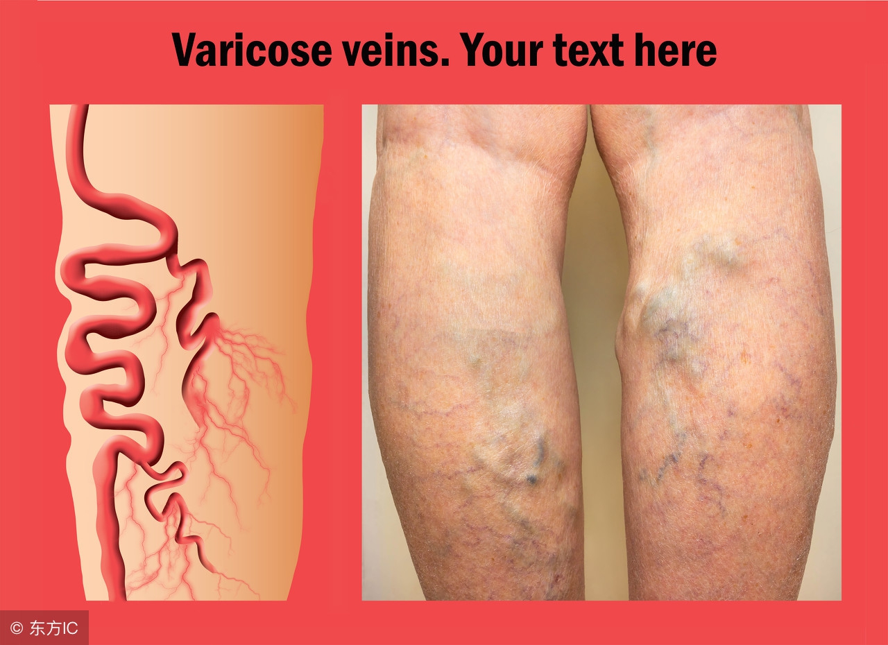 不手术治疗静脉曲张,不吃药也能治疗静脉曲张