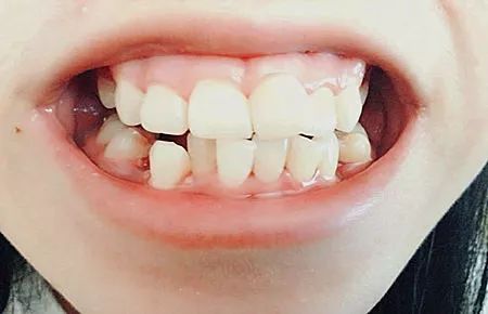 孩子老塞牙怎么办,吃饭塞牙有什么办法解决