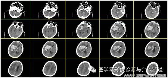 简述脑出血的内科治疗,脑出血中医解析