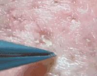 拔黑头粉刺过程细节,挤痘痘和拔黑头手法