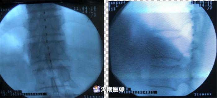 带状疱疹导致右侧胸口疼痛怎么办,得带状疱疹十几年了胸口疼