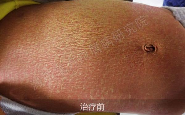 银屑病儿童好了有没有不复发的,治疗儿童银屑病全国哪家医院好