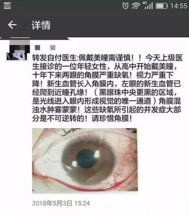 长期佩戴美瞳血管长到黑眼球附近,戴美瞳眼球上长了毛细血管