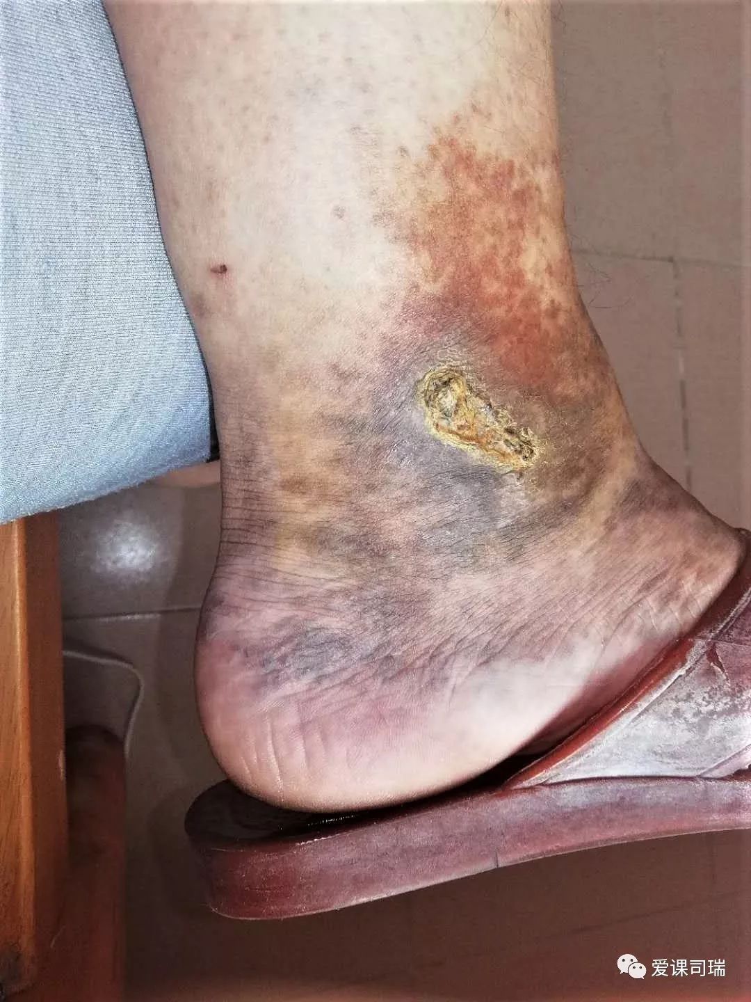 爱老师敲黑板,脚踝两侧变黑溃烂怎么回事