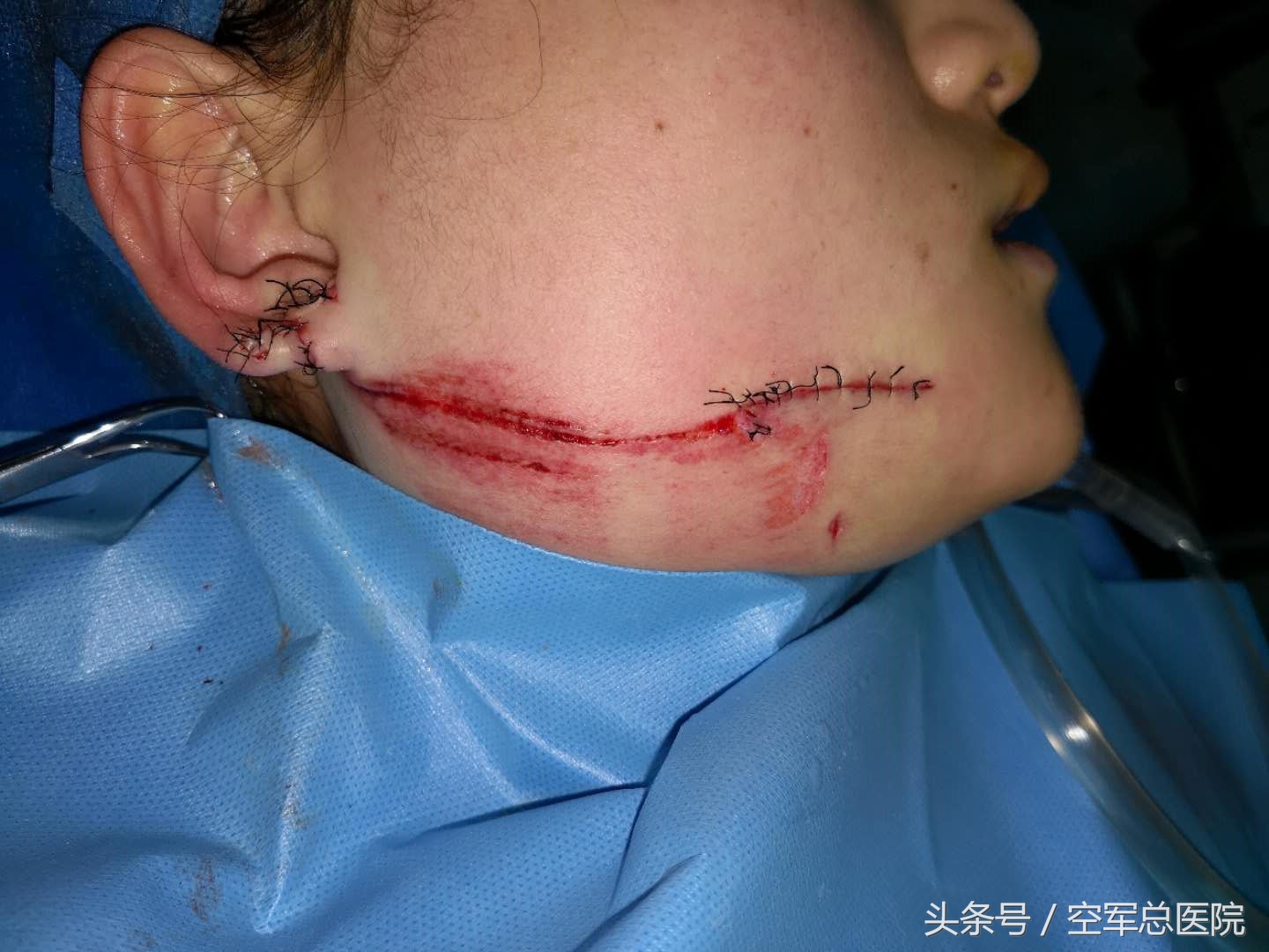 整形医生烧伤女孩,救治烫伤毁容女孩