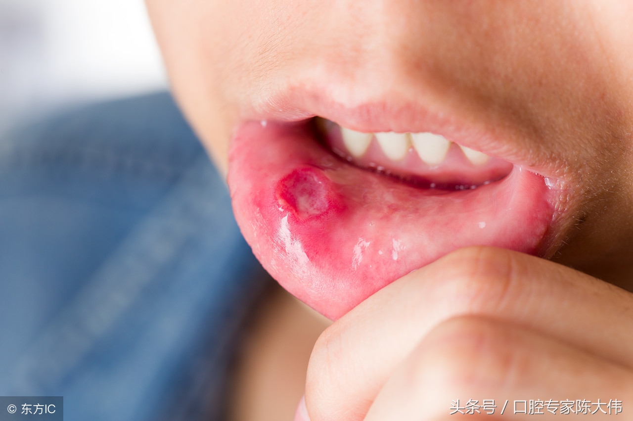 三个月宝宝口腔溃疡怎么治疗,口腔溃疡如何治疗