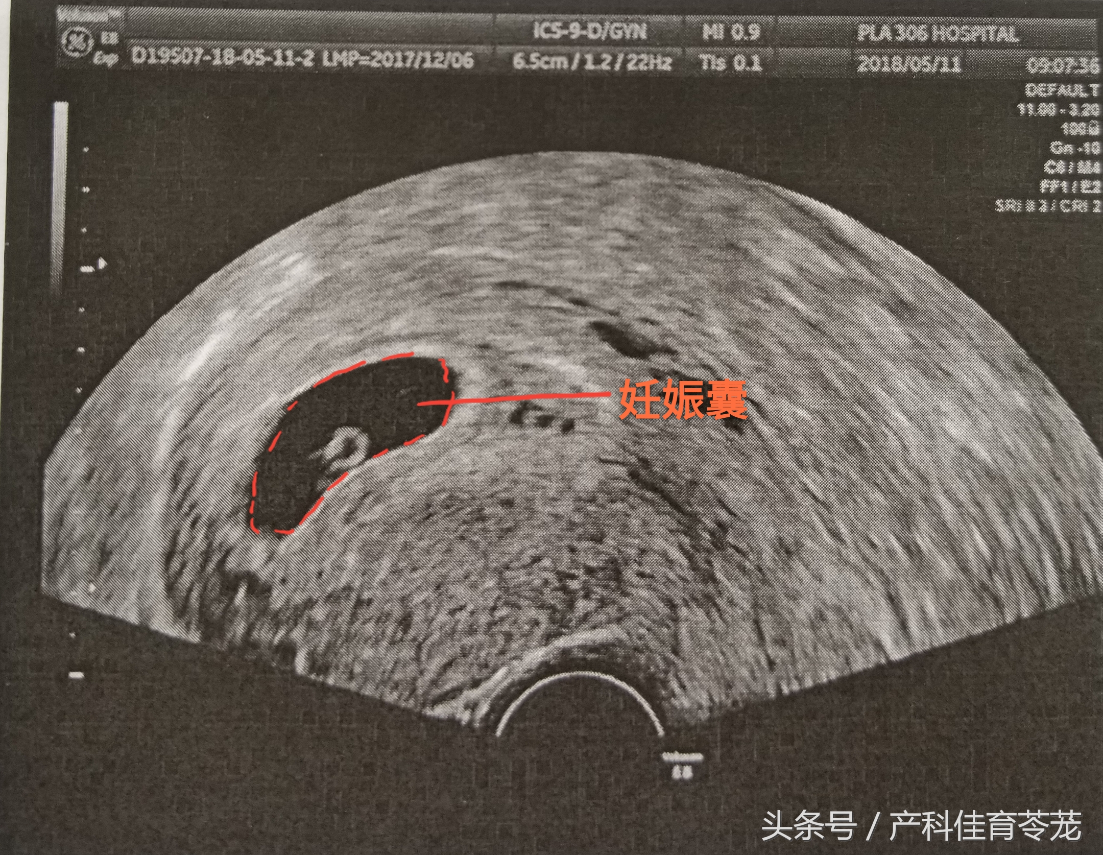 b超的3组数字代表什么,b超图片上的数字