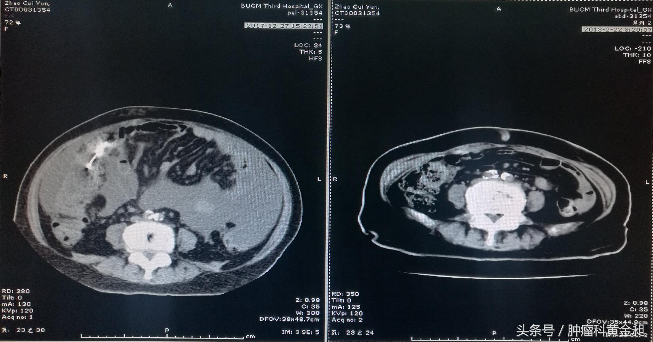中医治疗卵巢癌晚期,卵巢癌中西医结合治疗能痊愈吗