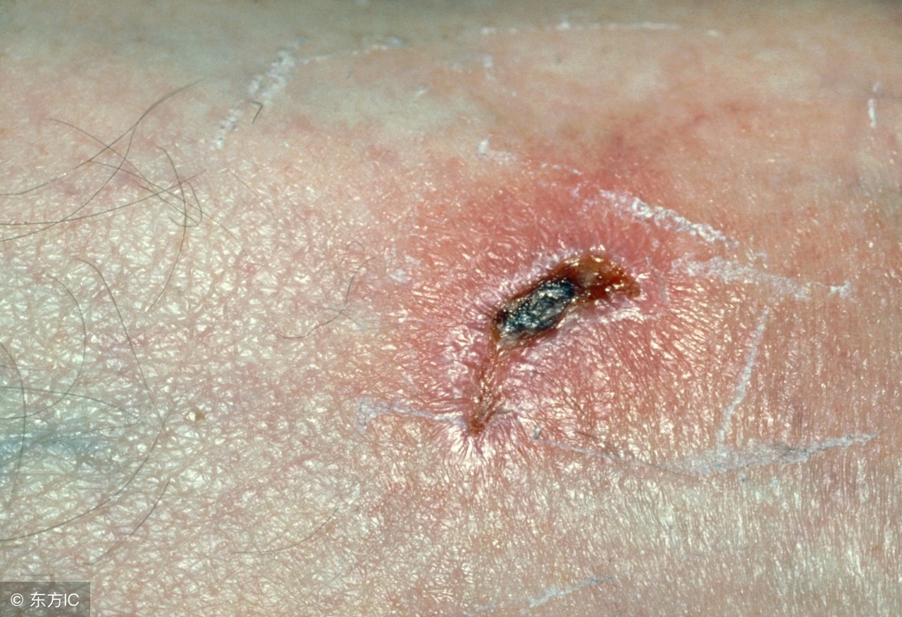 受伤了留疤了怎样消除疤痕,受伤后如何护理才能避免留疤