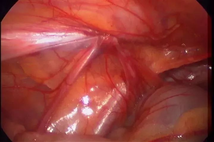3d腹腔镜微创疝气修补术,成人疝气腹腔镜微创
