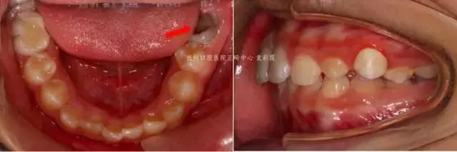 原来，上牙盖住下牙太多，也对牙齿有伤害！该怎么矫正？