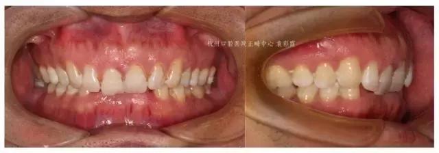 原来，上牙盖住下牙太多，也对牙齿有伤害！该怎么矫正？