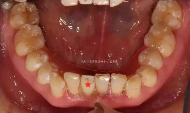 原来，上牙盖住下牙太多，也对牙齿有伤害！该怎么矫正？