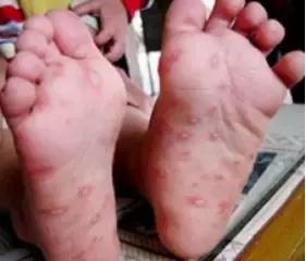 口腔疱疹发热怎么办,小孩发热口腔有疱疹