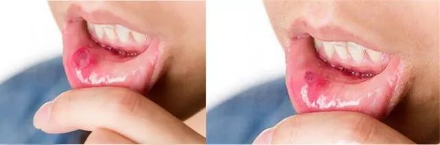 口腔溃疡药5秒止痛,口腔溃疡药1秒止痛