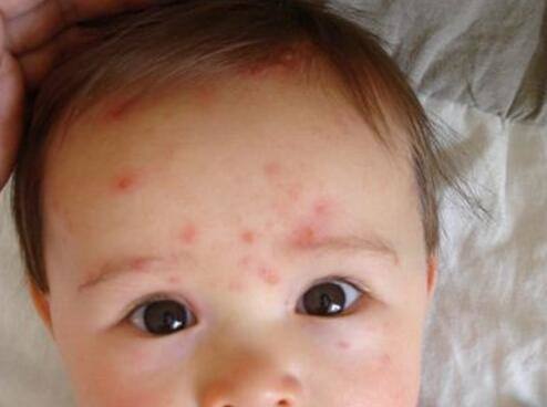 什么叫幼儿急疹,什么是少儿急疹