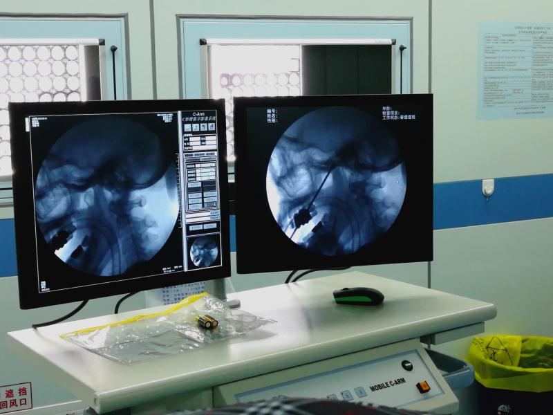 不开刀的微创治疗有哪些优势,没有微创直接开颅