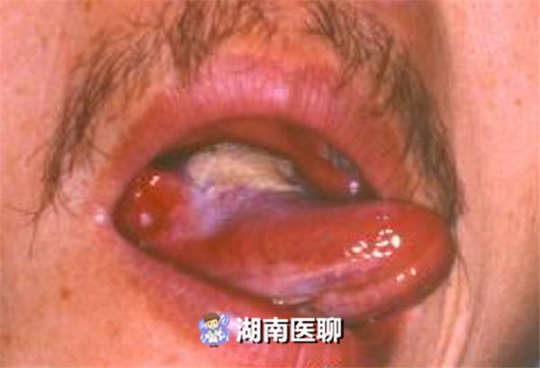 舌头烂了是舌头癌吗,如果舌头总破有舌癌风险么