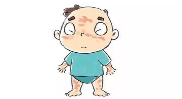 麻疹预防措施,麻疹的中医药预防与治疗方法