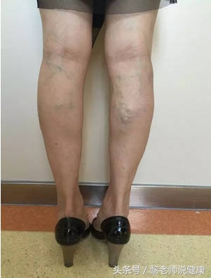 青筋很明显意味着什么,青筋凸起真的有人手会青筋暴起吗