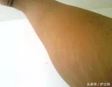 最近身体上出现的各种纹,身上竖着的纹是什么纹