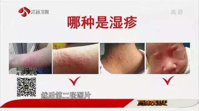 痱子湿疹傻傻分不清?最全湿疹指南,教你辨清症状,远离瘙痒~
