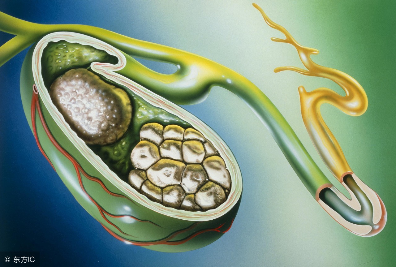 平静的胆结石不安分