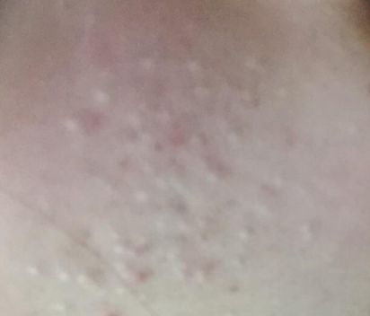 红蓝光祛痘可以去痘坑吗,红蓝光祛痘的最好方法