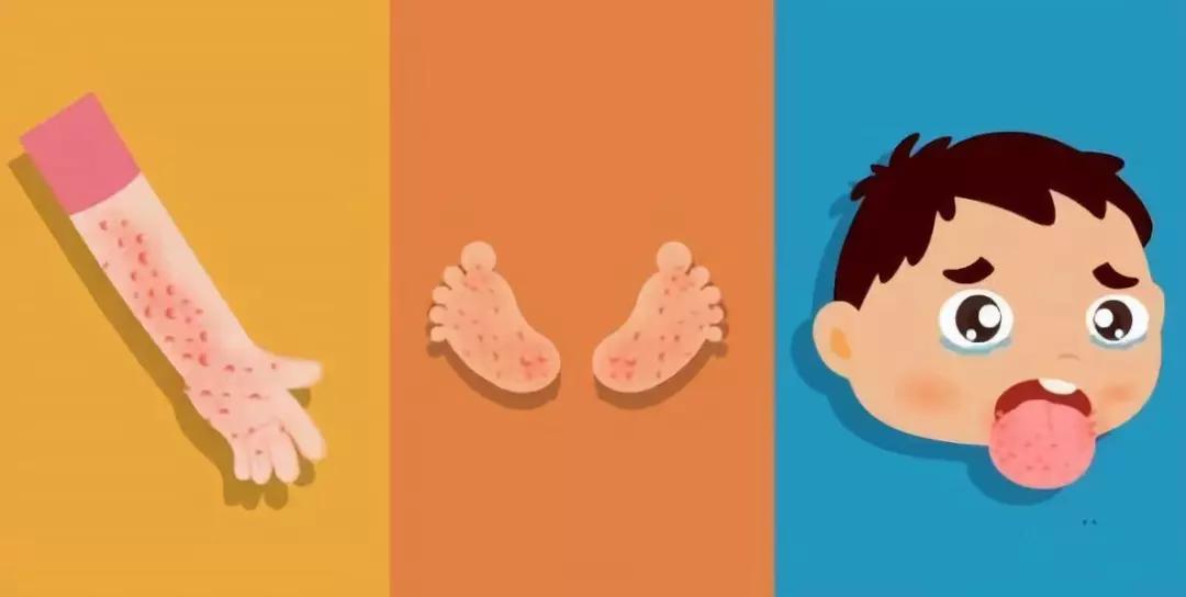 郑佑民中医师家传秘方精选:普济汤(小儿手足口病)