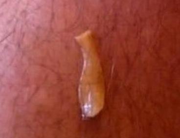 小女孩隐*处私**掉虫子?这个问题不少见