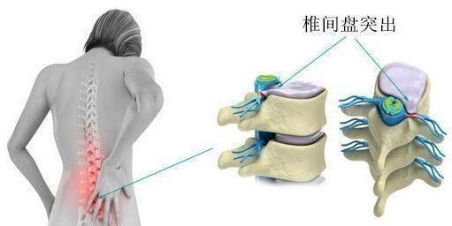 同样都是腰间盘为何你如此突出,颈4-5和颈5-6椎间盘突出