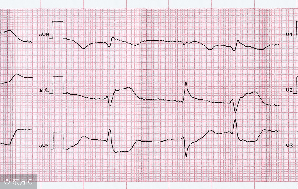 心脏早搏饮食要注意什么,心脏早搏饮食需要注意什么