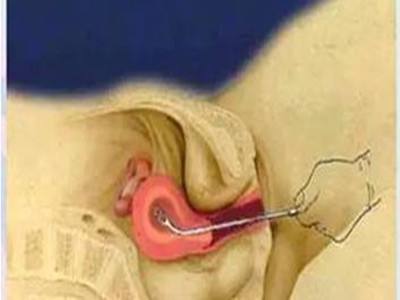 女人一生能承受多少次药物流产,女人一生能承受几次刮宫