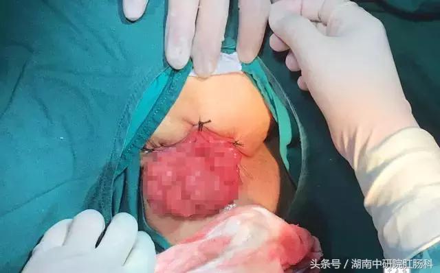 直肠癌康复视频,直肠癌患者术后的护理个案报告