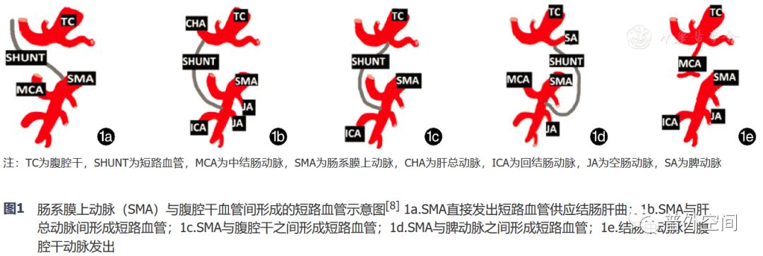 腹腔镜完整结肠系膜切除术相关血管变异与术中出血的应对措施（上）