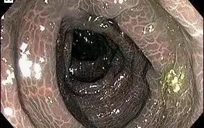 这种茶少喝!女子为治便秘连喝3年,大肠内壁全变黑了……