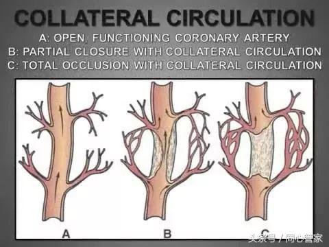 心脏血管堵塞能建立侧支循环吗,让心脏和血管强大的办法