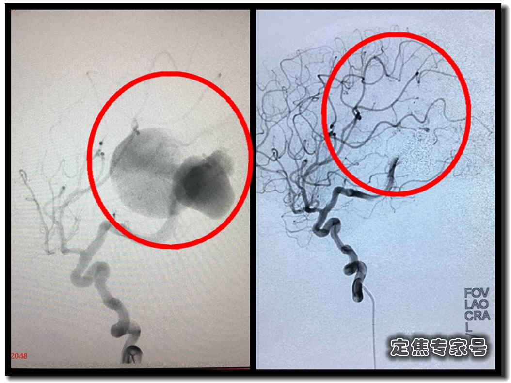 一岁男孩脑子里发现“小苹果”偷血，医生把“钢筋水泥”灌了进去