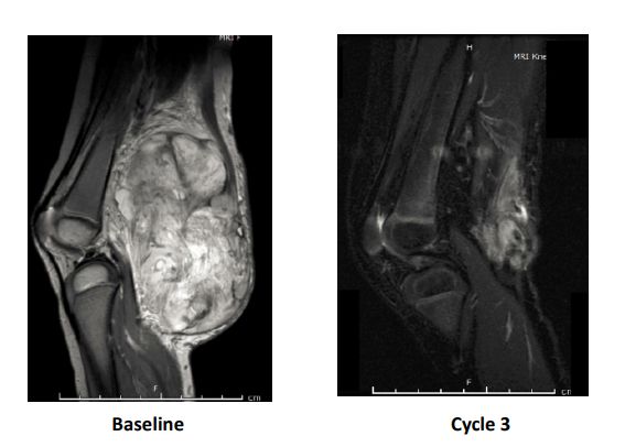 神奇制药抗癌药取得突破,神奇制药抗癌专利